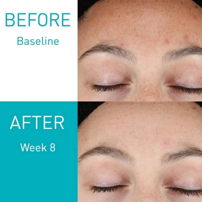 CeraVe Resurfacing Retinol Serum 30ml | Post-Acne & Pore Care